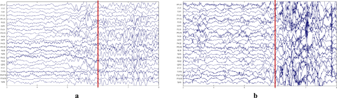 نوروتراپی: EEG